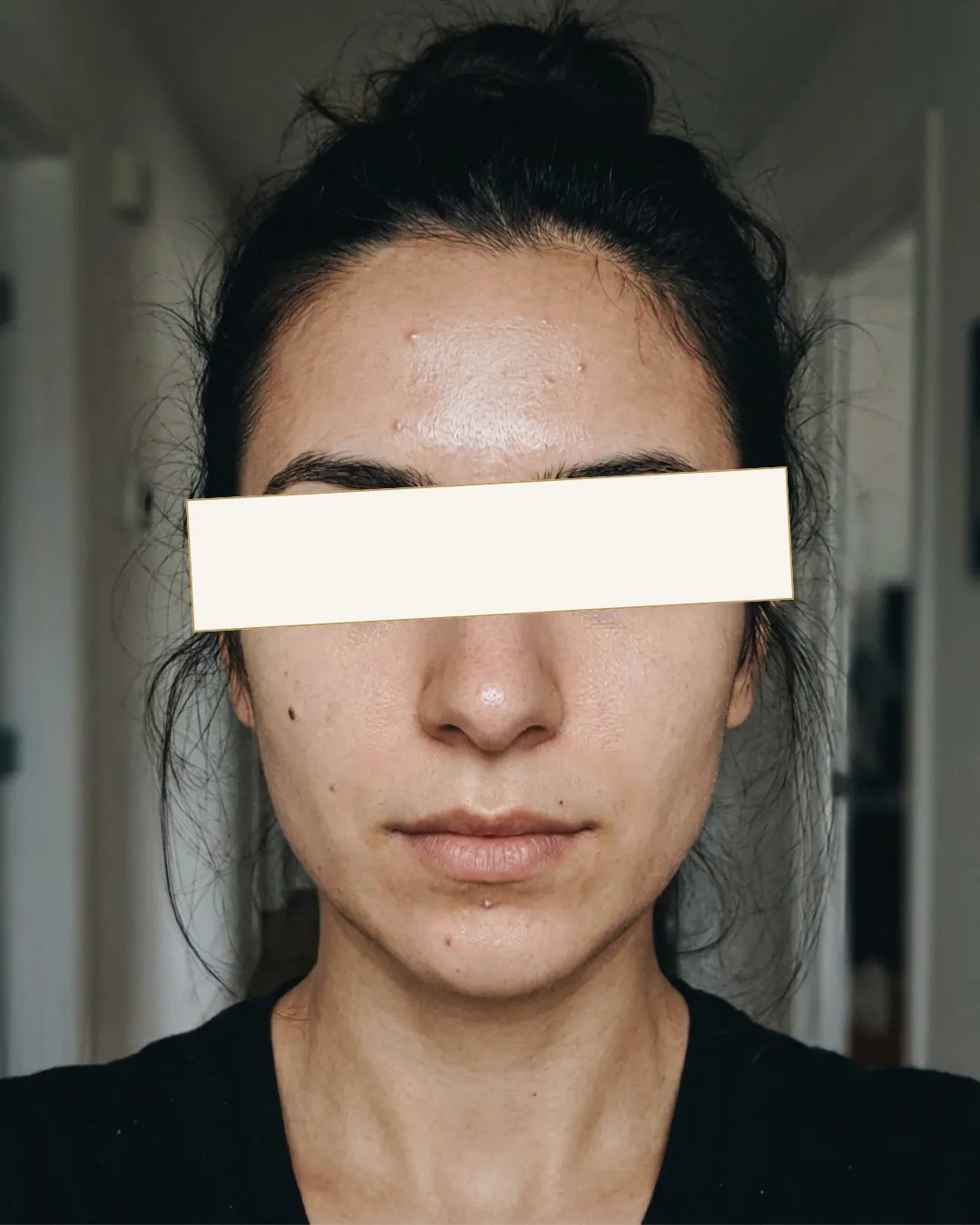 Калина, 27 - Затнати кожа и пори & досаден тен без сјај — Пред