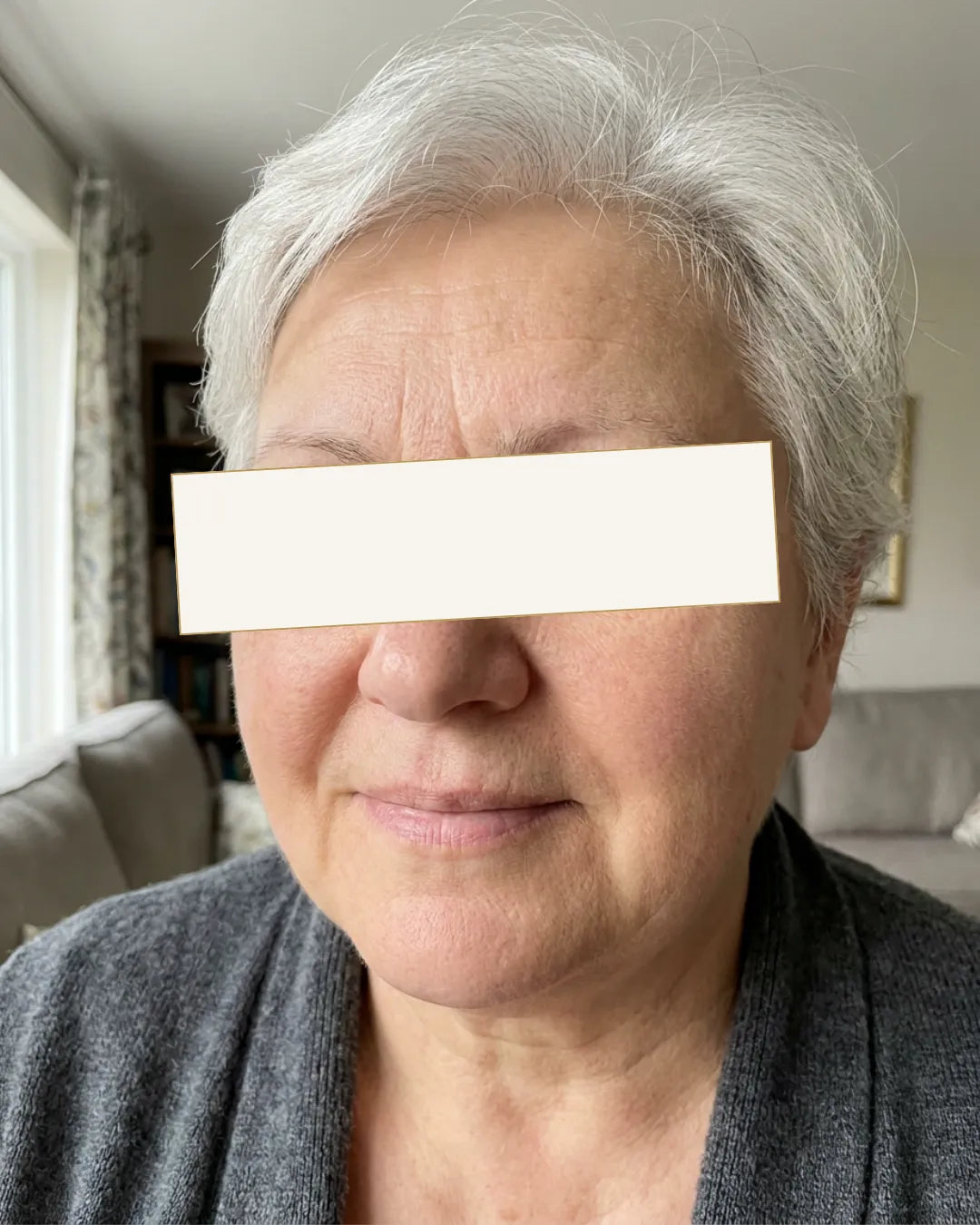 Радмила, 58 - Воспоставени брчки, сува и пупкава кожа — Пред